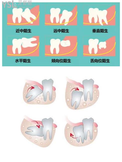 智齿类型图