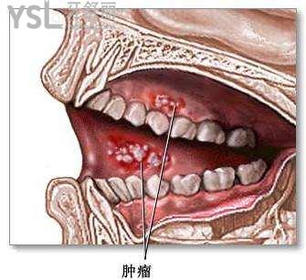 牙龈癌怎么治图片