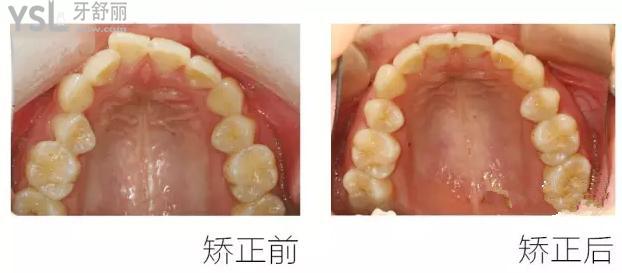 浅谈牙齿扩弓后颧骨变化以及扩弓会改变颧骨脸型吗