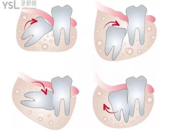 智齒的四種形態