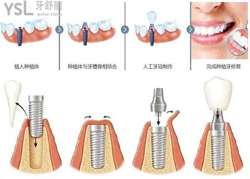 种植牙过程