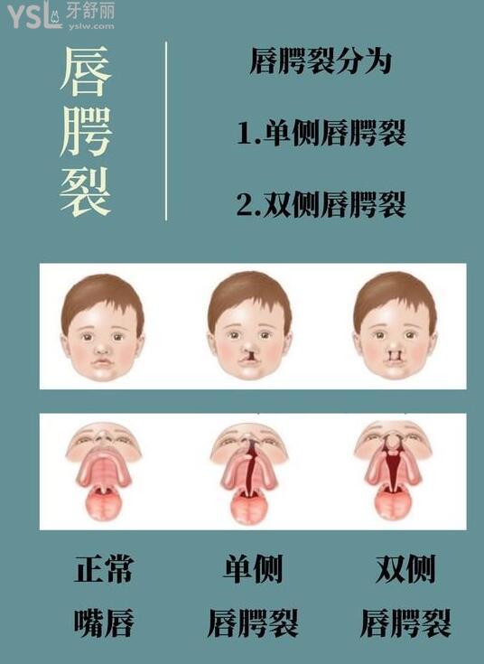 唇裂合并腭裂图片