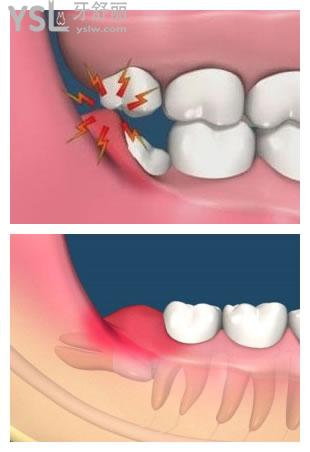 智齿冠周炎图片