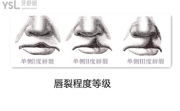 兔唇(唇裂)等级