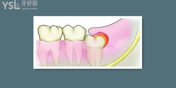 引起牙髓疾病的主要原因是什么，该如何预防和治疗