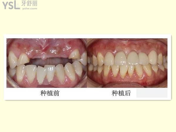 表以及内江矫正牙齿哪个医院好统统搞定