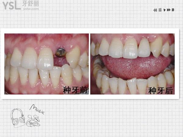 种植牙前后对比图