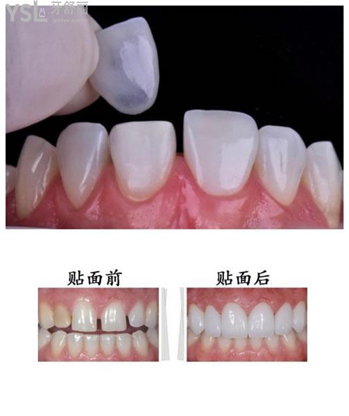 全瓷牙前后对比图片