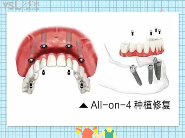 all-on-4/6种植牙技术