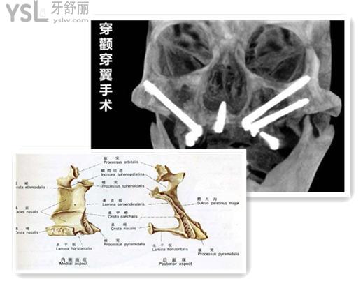 穿翼种植牙示意图 穿翼种植牙风险