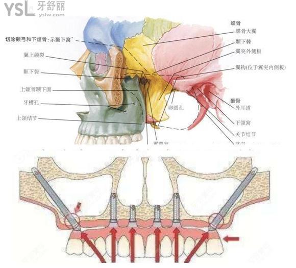 穿翼种植牙示意图 穿翼种植牙风险