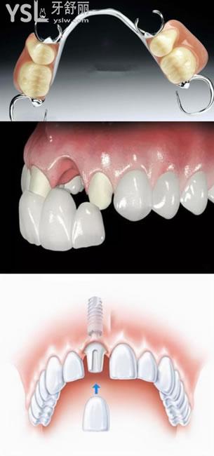 固定义齿,活动义齿,种植牙