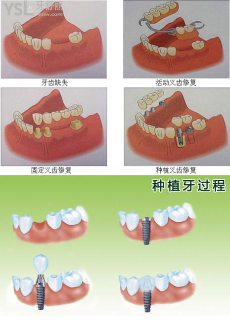 农村镶牙的过程图解图片