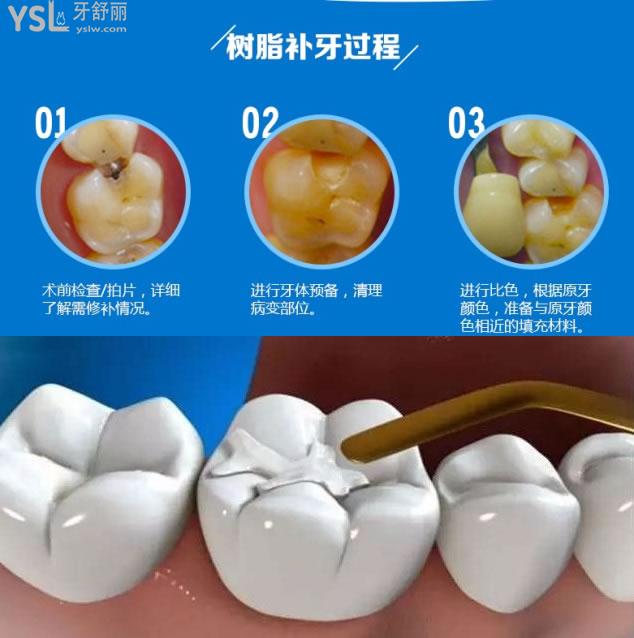 十大树脂补牙材料品牌排行榜公布:排名前十的树脂补牙(优势)多少钱