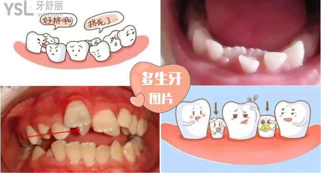 门牙中间有多生牙图片图片