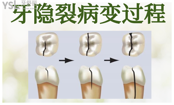 健康小常识:牙齿隐裂是什么原因造成的?png