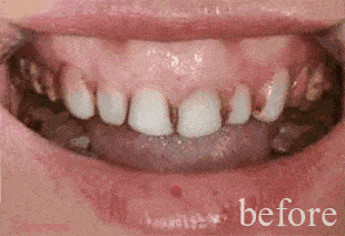 嵌体为什么比牙冠贵、牙齿做嵌体和牙冠的区别