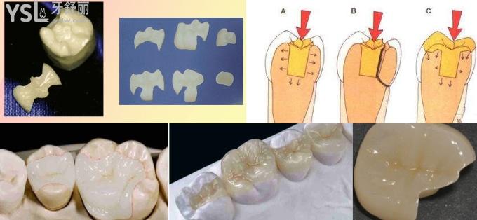 嵌体为什么比牙冠贵、牙齿做嵌体和牙冠的区别