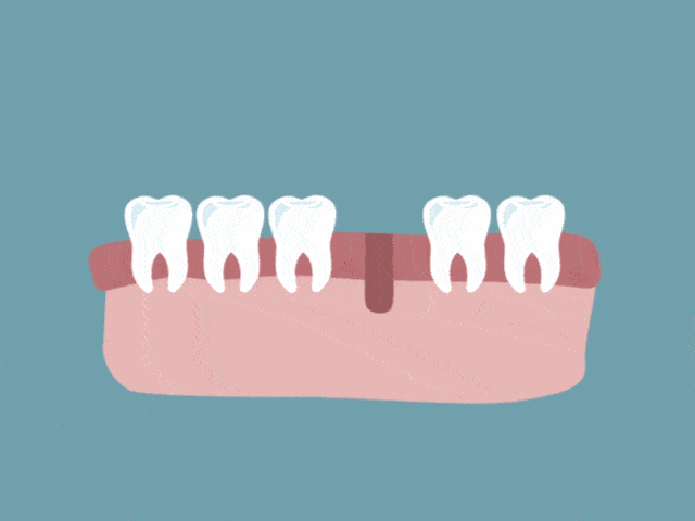 种植牙能用多久？
