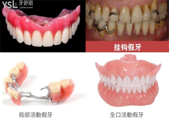 无挂钩精密假牙比普通假牙的优缺点和价格