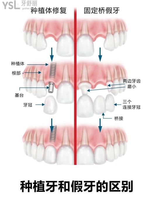 种植牙和假牙的区别