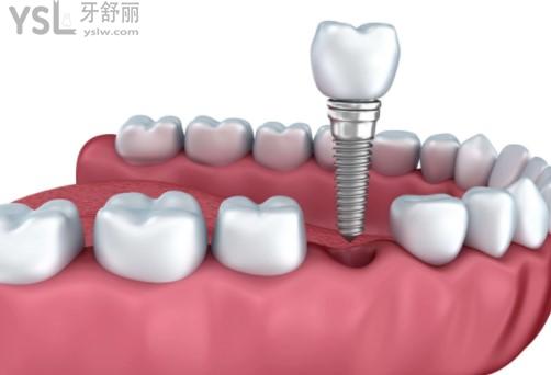 杭州哪家医院种植牙技术比较好，杭州种植牙医院排名榜