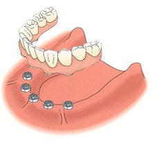 种植牙前需要注意事项，十大种植牙常见问题答疑