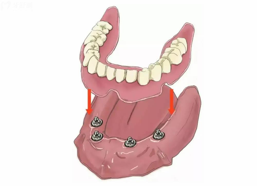 半口半固定种植牙