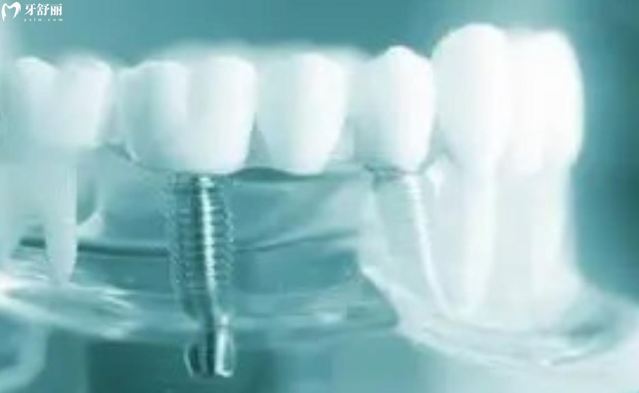 法国安卓健种植牙质保几年