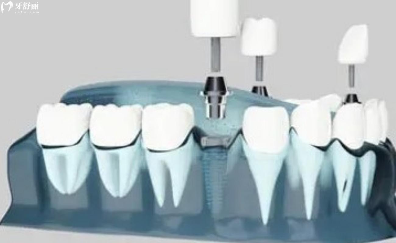 法国安卓健种植牙质保几年