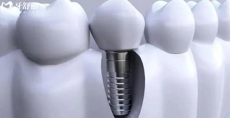 深圳正规牙科种颗牙多少钱 完整版深圳牙科收费标准
