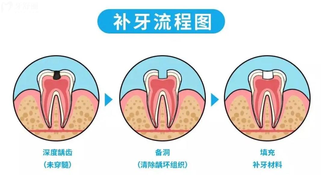 补牙图片过程图片大全图片