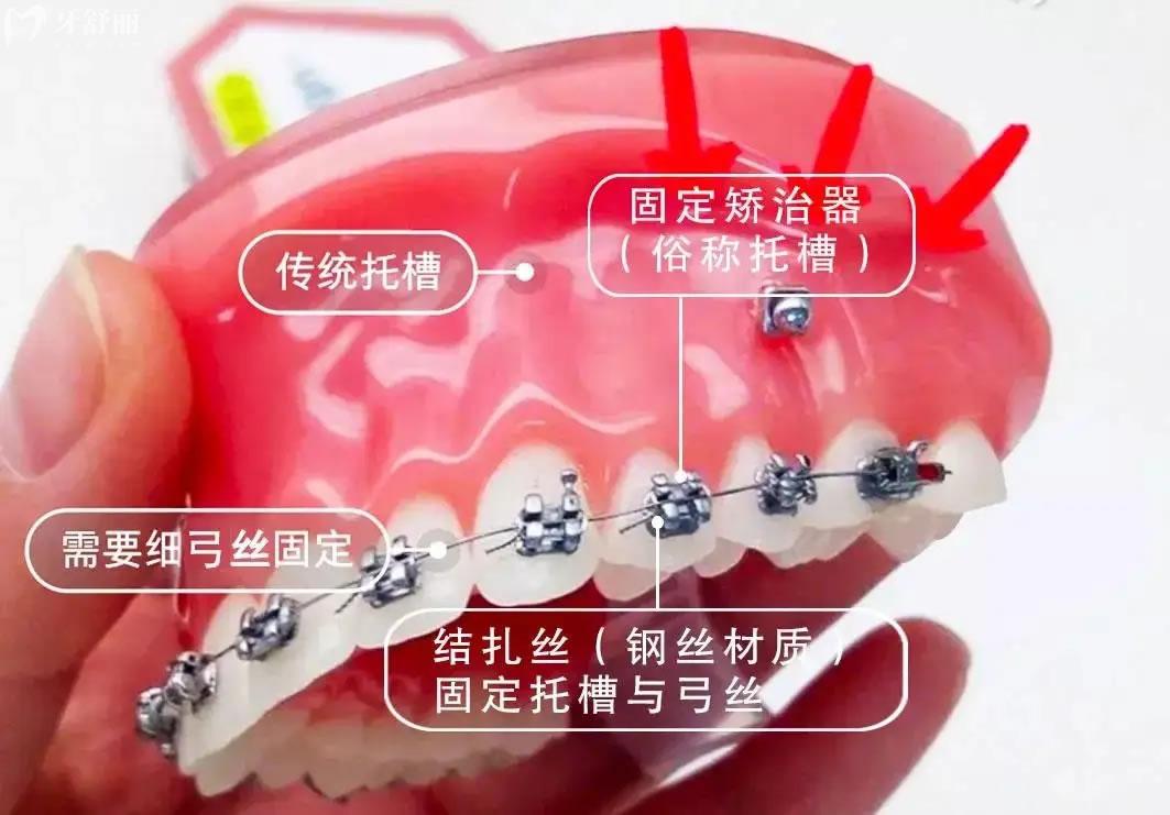 牙齿矫正感受心得体会