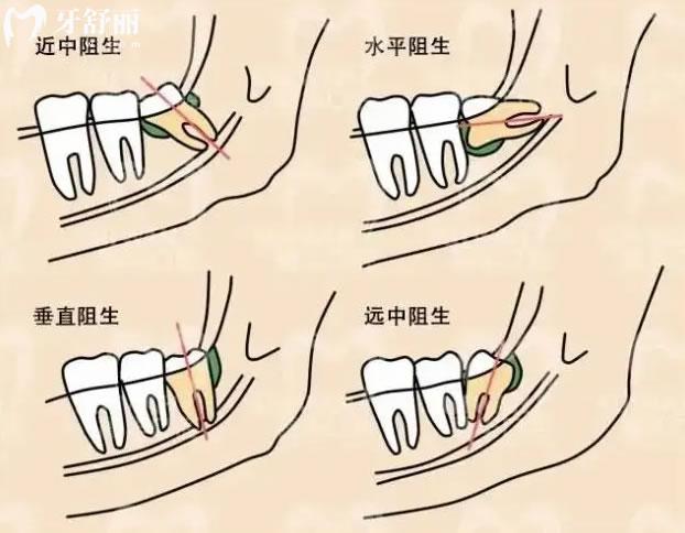 阻生智齿分类图片图片