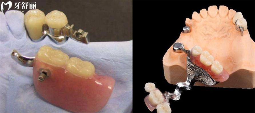 2万块能种全口牙吗？盘点半口全口牙是怎么修复的？