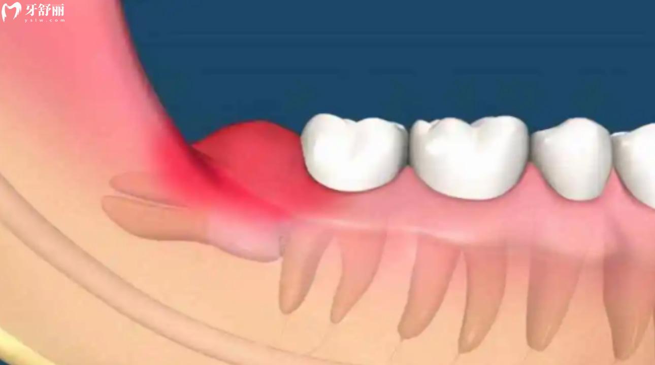 牙龈肿了个肉坨怎么办?有什么消肿的好办法?