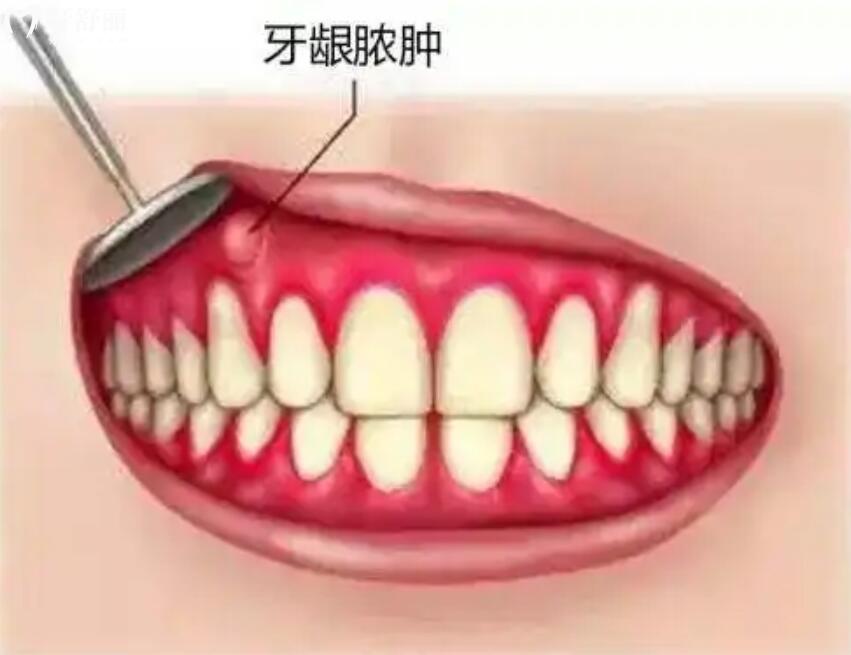 为什么有牙周炎不能整牙？想做牙齿矫正的我改怎么办？