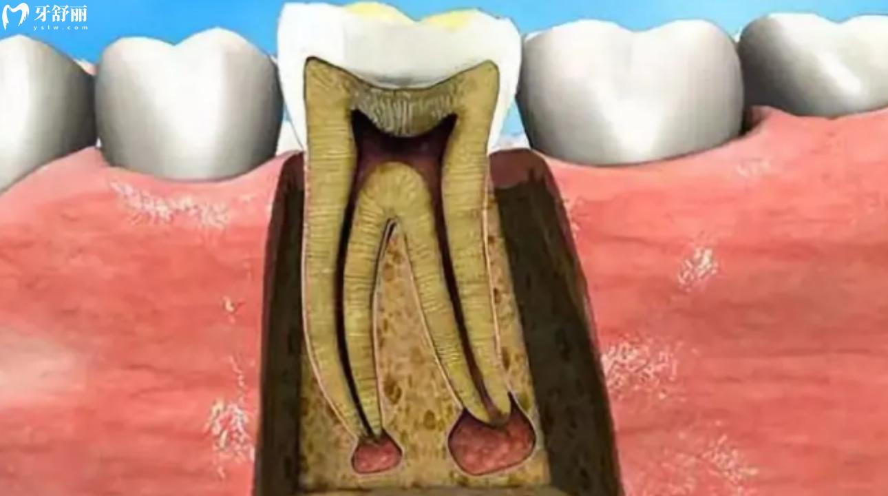 牙神经是啥样的图片图片