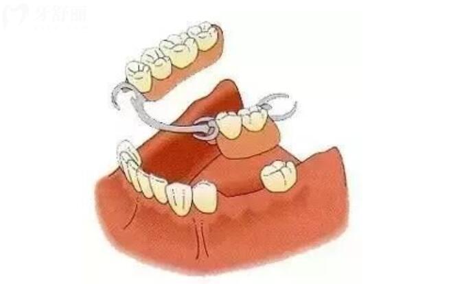 镶牙和种牙的优缺点