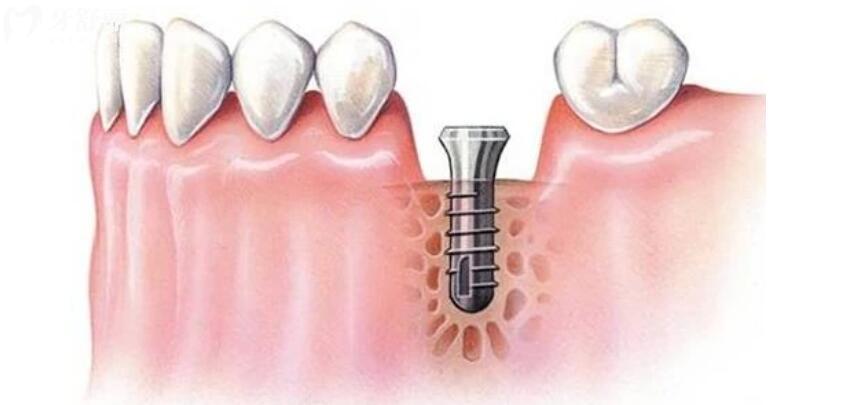 镶牙和种牙的优缺点