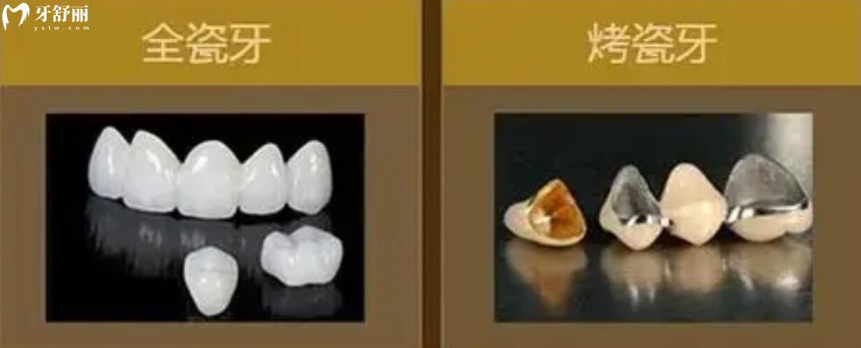 烤瓷牙与全瓷牙的区别和优缺点都有什么?到底应该怎么选择