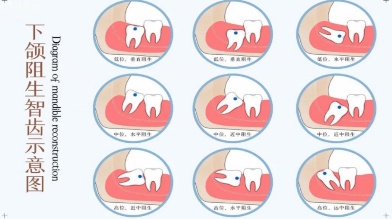 十种智齿不能拔的原因有哪些?哪些智齿可以拔除?