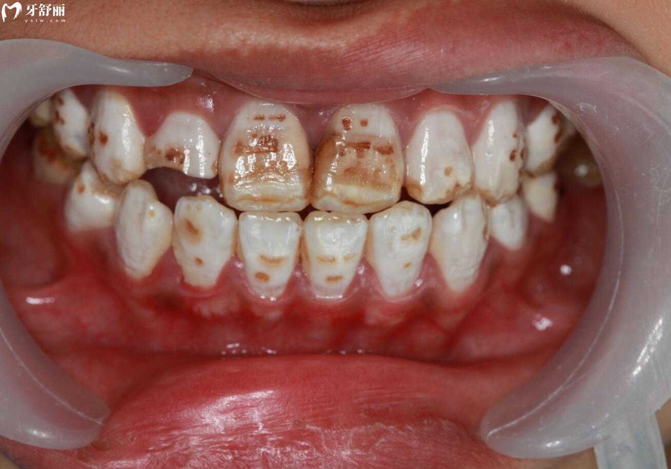 常见的牙齿疾病 - 知乎