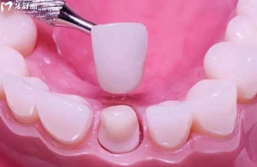 牙体缺损粘接修复术是什么意思