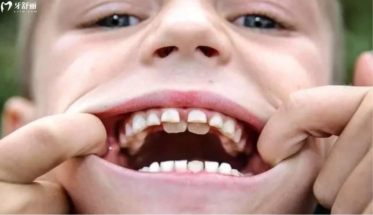 儿童换牙的时候该注意些什么.jpg