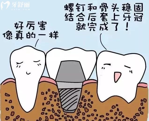 种植牙的优势性能