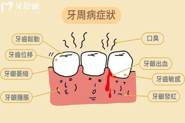 牙周病的症状有哪些