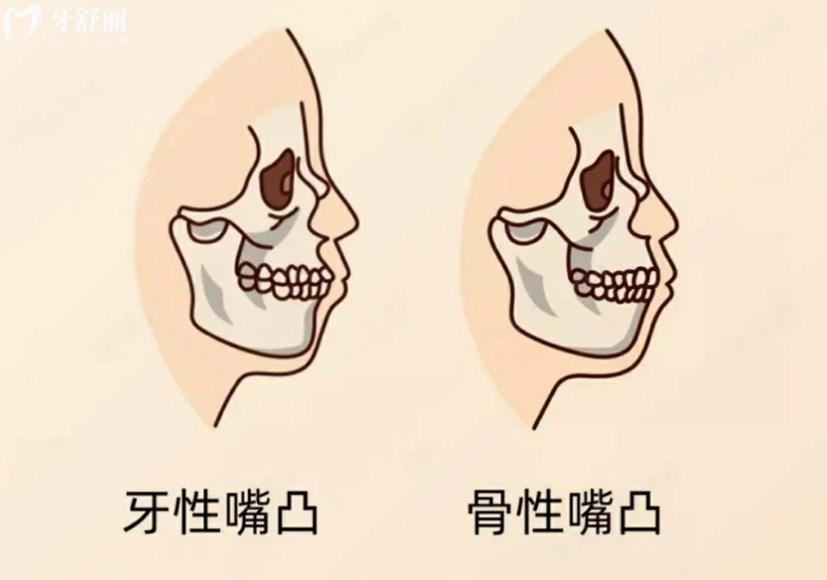 骨性嘴凸和牙性嘴凸区别