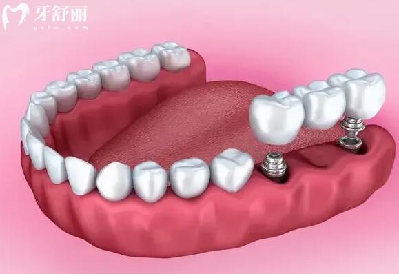 清远口腔医院收费明细曝光,收费实惠且种植牙2800牙齿矫正5800
