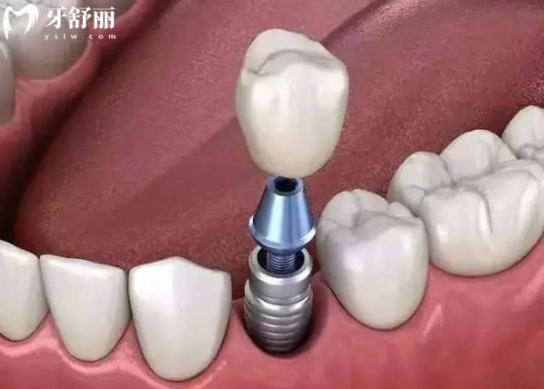 活动义齿和固定义齿哪个对相邻牙危害大